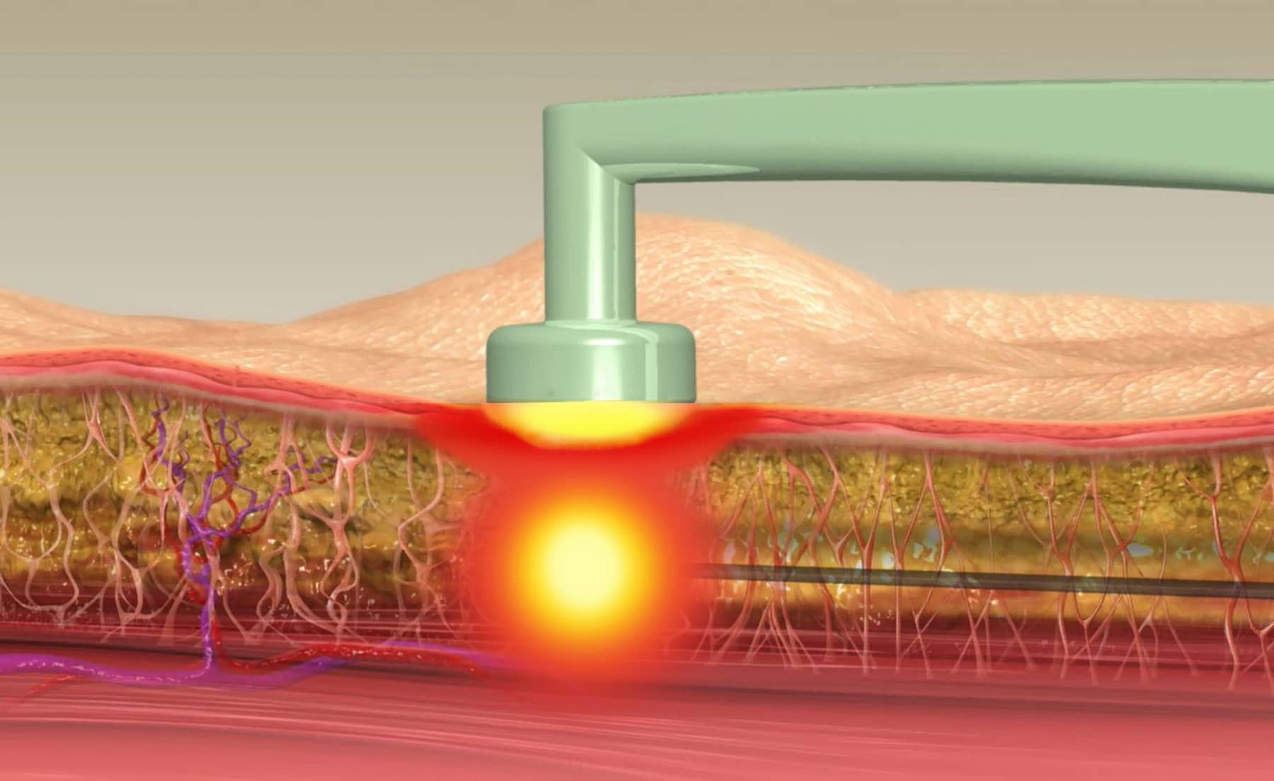 bodytite-technology-graphic-fat-preview-1